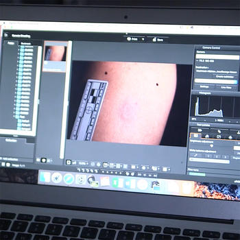Laptop screen display showing a bruise being measured with a ruler.